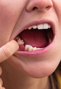 a person showing their missing tooth